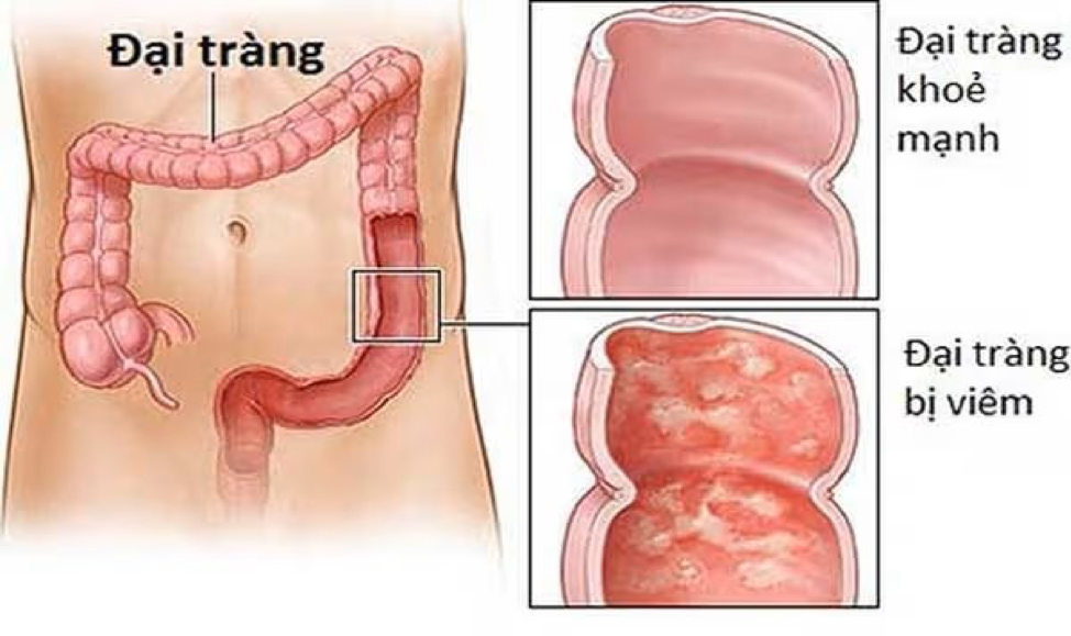 đại tràng.png